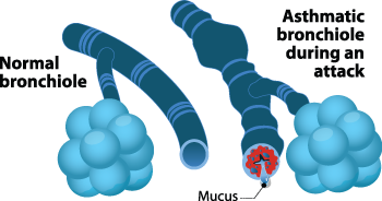 Asthma Tubes